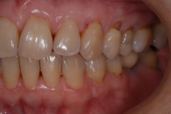 Abrasioni del colletto del dente