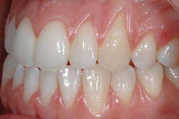 Recessioni gengivali da errato spazzolamento