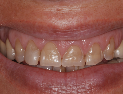 Perdita di smalto dentale da alimentazione acida