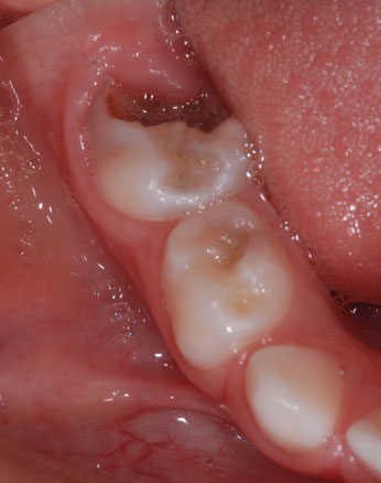 carie dente da latte demineralizzato