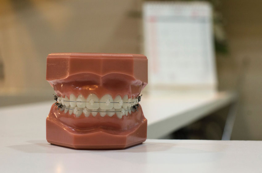 Come si pulisce un apparecchio ortodontico?