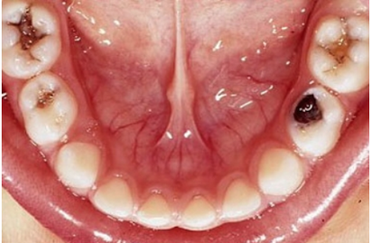 carie nei denti del bambino