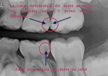 radiografia digitale nel bambino dove si vedono le carie nascoste tra dente e dente