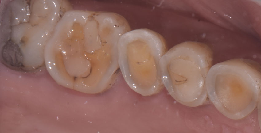 usura e erosione dei denti con sensibilità e dolore
