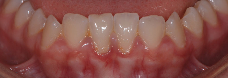 gengive infiammate gonfie e sanguinanti