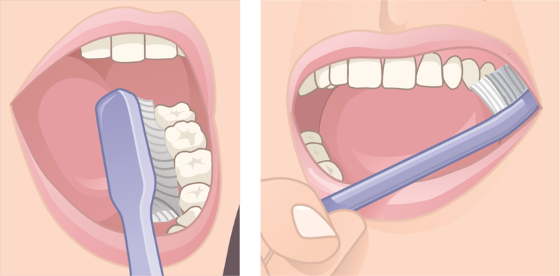 Appoggiare le setole dello spazzolino sulla gengiva  e spazzolare i denti muovendosi in verticale dalla gengiva al dente sia nella parte interna che esterna per allontanare la placca dal dente