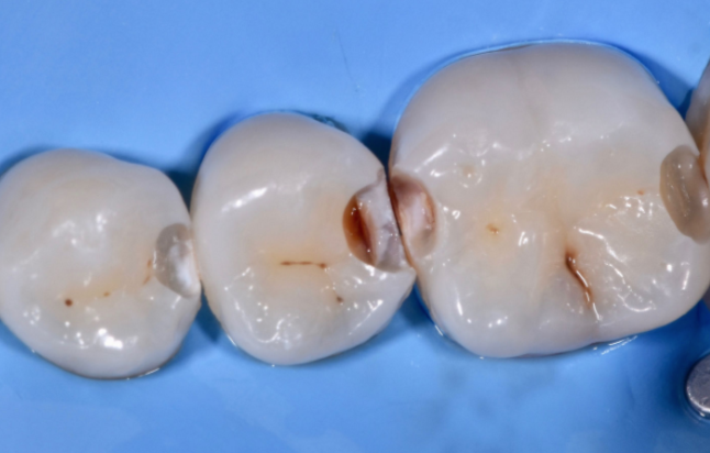 carie tra dente e dente 