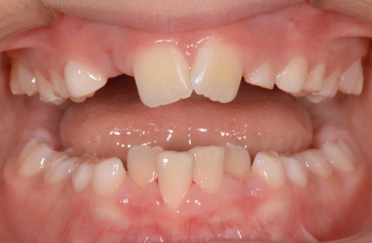 Esistono le gengive retratte nei bambini?La risposta è …SNO!