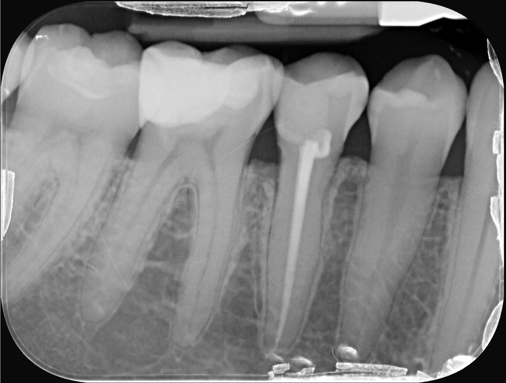 Rx periapicale dentale