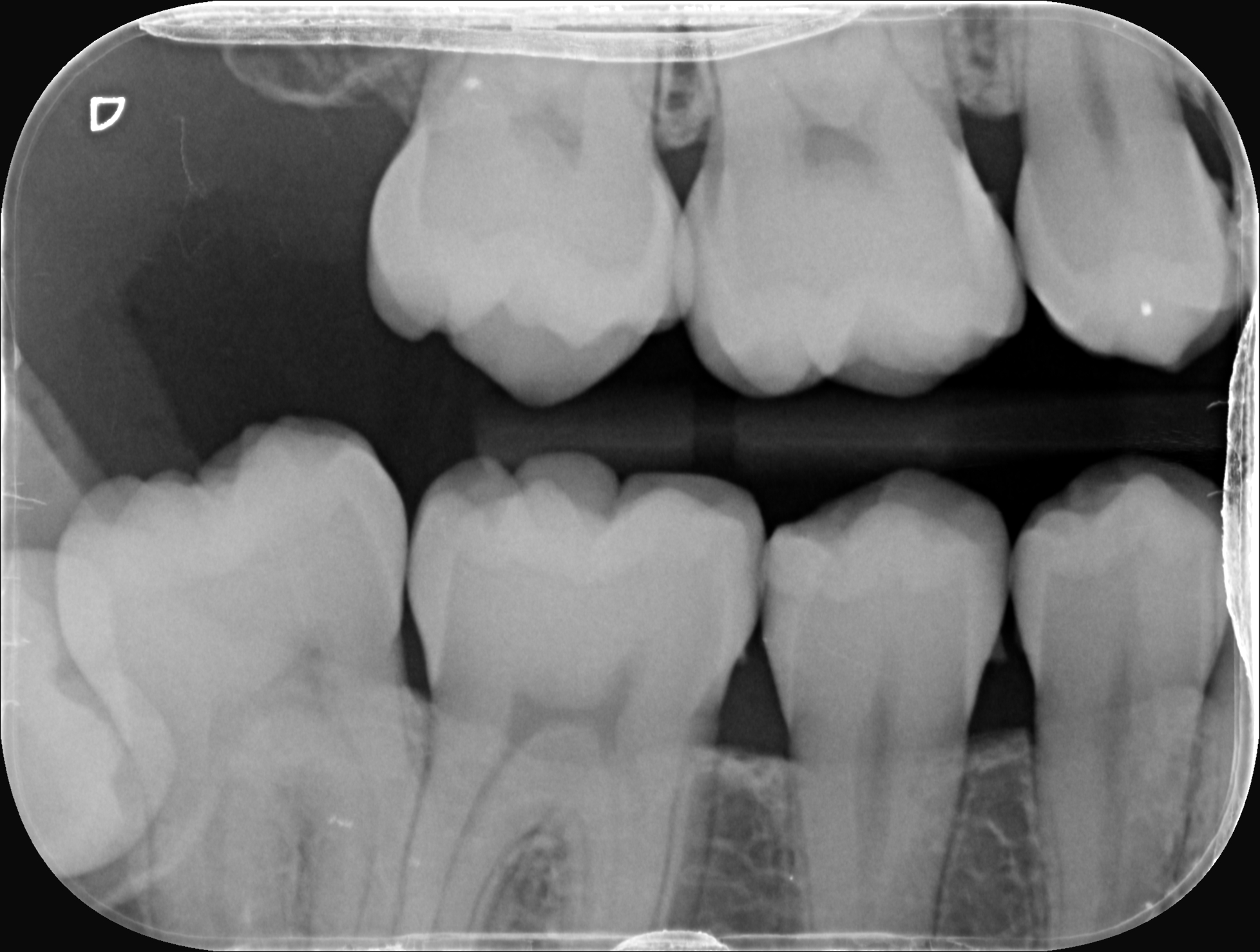 Rx bitewing controllo carie