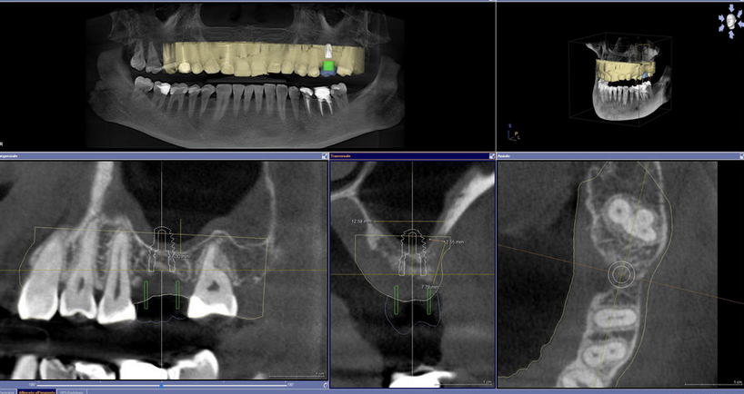 Tomografia computerizzata cone beam 