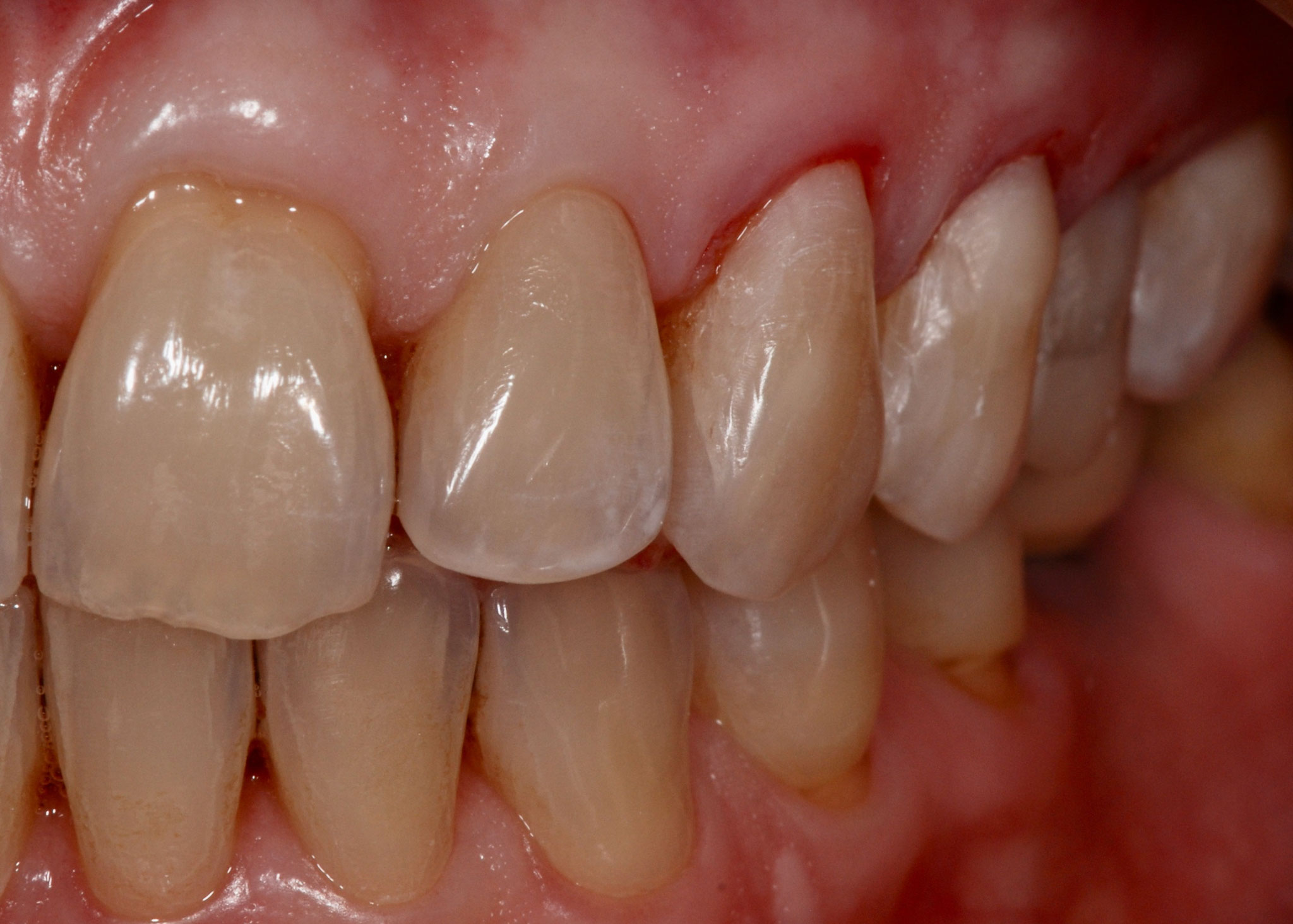 Restauri cervicali appena eseguiti