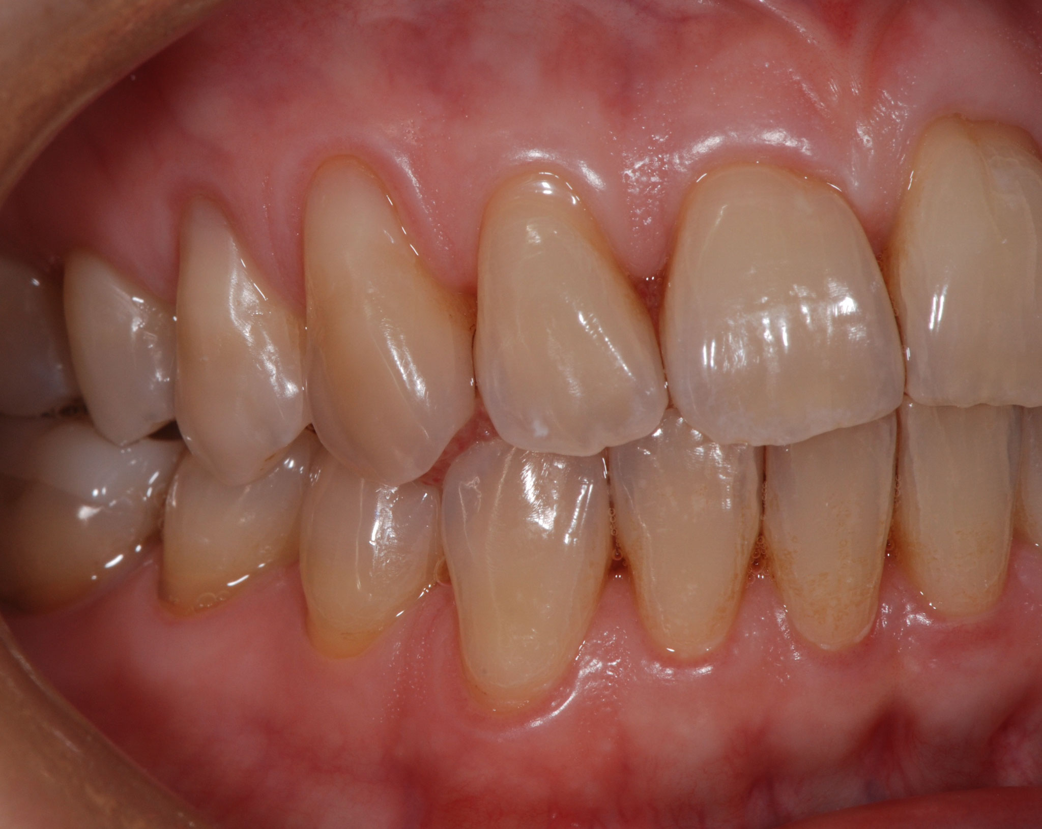 Lato destro a guarigione avvenuta, 1 mese dopo il trattamento delle abrasioni